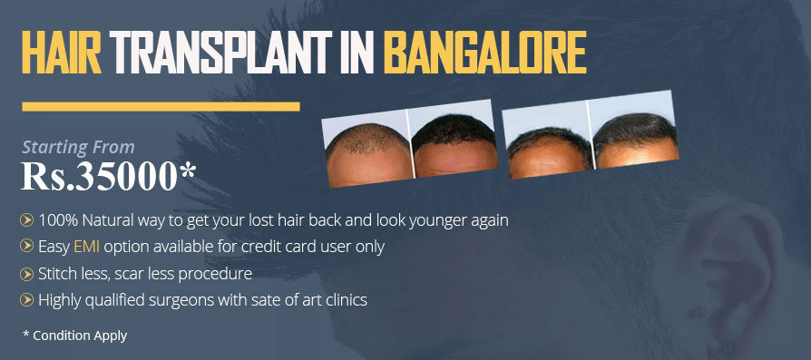 Natural Hair Transplant Bangalore - Bangalore, India