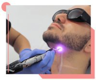 Laser Hair Removal for Men