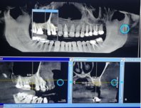 MAB Dental Implants Tijuana - Dr. Mark Anthony Bartell