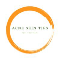 Acne skin tips | Acne consultant