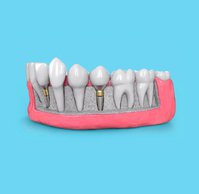 Adelaide Tooth Removals