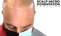 Scalp Micropigmentation Edmonton