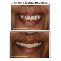 North Texas Dental Surgery Wisdom Teeth and Denture Implant Center