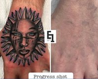 Error Ink Tattoo Removal Specialists